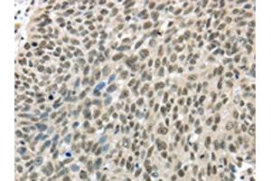 The image on the left is immunohistochemistry of paraffin-embedded Human lung cancer tissue using ABIN7131308(TBL1Y Antibody) at dilution 1/20, on the right is treated with fusion protein. (TBL1Y antibody)