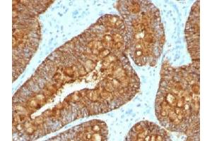 IHC testing of FFPE human colon carcinoma with MAML3 antibody (clone MAML3/1303). (MAML3 antibody)