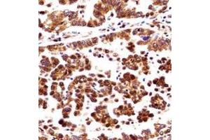 Immunohistochemistry analysis in formalin fixed and paraffin embedded human lung adenocarcinoma reacted with ORC3 / LATHEO Antibody (N-term) followed which was peroxidase conjugaed to the secondary antibody and followed by DAB staining.