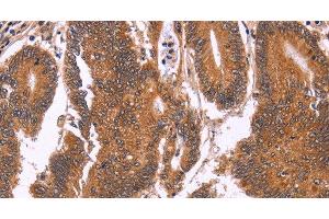 Immunohistochemistry of paraffin-embedded Human colon cancer tissue using CDC37L1 Polyclonal Antibody at dilution 1:60 (CDC37L1 antibody)