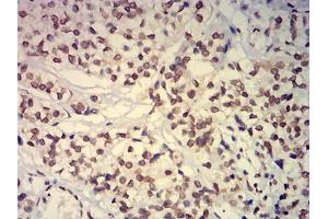 Immunohistochemical analysis of paraffin-embedded bladder cancer tissues using EHMT2 mouse mAb with DAB staining. (EHMT2 antibody  (AA 317-471))