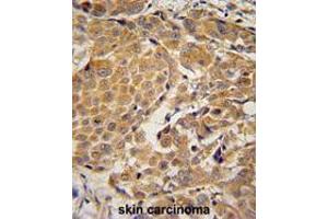 AWAT2 Antibody (C-term) immunohistochemistry analysis in formalin fixed and paraffin embedded human skin carcinoma followed by peroxidase conjugation of the secondary antibody and DAB staining.