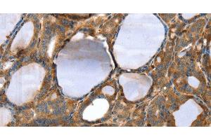 Immunohistochemistry of paraffin-embedded Human thyroid cancer tissue using TAGLN Polyclonal Antibody at dilution 1:30 (Transgelin antibody)