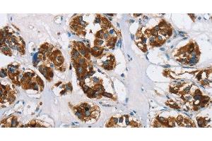 Immunohistochemistry of paraffin-embedded Human thyroid cancer using HINT2 Polyclonal Antibody at dilution of 1:50 (HINT2 antibody)