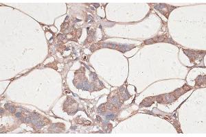 Immunohistochemistry of paraffin-embedded Human breast cancer using LAMC1 Polyclonal Antibody at dilution of 1:100 (40x lens). (Laminin gamma 1 antibody)