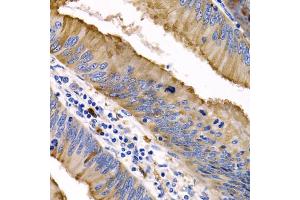 Immunohistochemistry of paraffin-embedded human colon cancer using IL9 antibody (ABIN5974970) at dilution of 1/200 (40x lens). (IL-9 antibody)