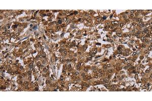 Immunohistochemistry of paraffin-embedded Human liver cancer using TBX5 Polyclonal Antibody at dilution of 1:35 (T-Box 5 antibody)