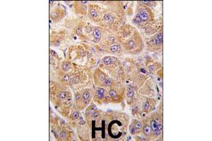 Formalin-fixed and paraffin-embedded human hepatocellular carcinoma reacted with IDE polyclonal antibody  , which was peroxidase-conjugated to the secondary antibody, followed by DAB staining.