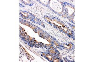 Anti-Tec antibody, IHC(P) IHC(P): Human Intestinal Cancer Tissue (NR4A3 antibody  (C-Term))