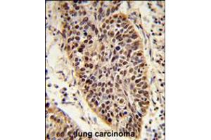 Formalin-fixed and paraffin-embedded human lung carcinoma reacted with XPA Antibody , which was peroxidase-conjugated to the secondary antibody, followed by DAB staining. (XPA antibody  (C-Term))