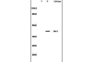 Formalin-fixed and paraffin embedded human endometrial carcinoma tissue labeled with Anti LTB4-R1 Polyclonal Antibody,Unconjugated (ABIN748628) at 1:100 followed by conjugation to the secondary antibody and DAB staining. (Leukotriene B4 Receptor/BLT antibody  (AA 101-200))