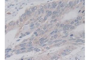 Detection of LACTb in Human Colorectal cancer Tissue using Polyclonal Antibody to Lactamase Beta (LACTb) (LACTB antibody  (AA 313-547))