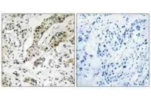 Immunohistochemistry analysis of paraffin-embedded human breast carcinoma tissue using TCEAL3/5/6 antibody. (TCEAL3/TCEAL5/TCEAL6 antibody)