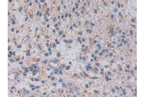 Detection of TOP3 in Human Glioma Tissue using Polyclonal Antibody to Topoisomerase III (TOP3) (TOP3 antibody  (AA 35-179))