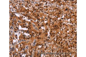 Immunohistochemistry of Human thyroid cancer using GPR124 Polyclonal Antibody at dilution of 1:40 (GPR124 antibody)