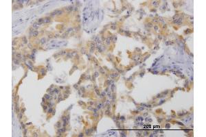 Immunoperoxidase of monoclonal antibody to NTNG2 on formalin-fixed paraffin-embedded human lung cancer. (Netrin G2 antibody  (AA 21-119))