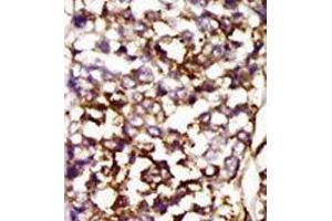 Formalin-fixed and paraffin-embedded human cancer tissue reacted with the primary antibody, which was peroxidase-conjugated to the secondary antibody, followed by AEC staining. (CDK4 antibody  (C-Term))