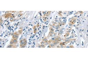 Immunohistochemistry of paraffin-embedded Human liver cancer tissue using LRP6 Polyclonal Antibody at dilution 1:60 (LRP6 antibody)