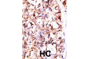 Formalin-fixed and paraffin-embedded human cancer tissue reacted with the primary antibody, which was peroxidase-conjugated to the secondary antibody, followed by AEC staining. (PP5 antibody  (C-Term))