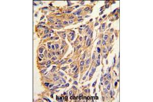Formalin-fixed and paraffin-embedded human lung carcinoma tissue reacted with PPT1 antibody , which was peroxidase-conjugated to the secondary antibody, followed by DAB staining.