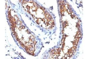 Formalin-fixed, paraffin-embedded human testicular carcinoma stained with CD99 antibody (HO36-1. (CD99 antibody)