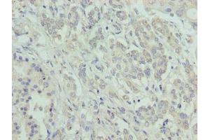 Immunohistochemistry of paraffin-embedded human pancreatic cancer using ABIN7144801 at dilution of 1:100 (ATXN7L1 antibody  (AA 1-146))