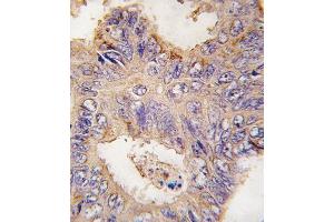 Formalin-fixed and paraffin-embedded human colon carcinoma tissue reacted with TRAF2 antibody (C-term) (ABIN392282 and ABIN2841948) , which was peroxidase-conjugated to the secondary antibody, followed by DAB staining. (TRAF2 antibody  (C-Term))