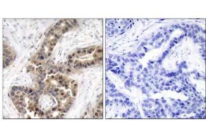 Immunohistochemical analysis of paraffin-embedded human breast carcinoma tissue using p21Cip1 (phospho-Thr145) antibody (E011206). (p21 antibody  (pThr145))