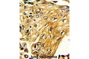 Formalin-fixed and paraffin-embedded human lung carcinoma reacted with IFNGR2 Antibody (C-term), which was peroxidase-conjugated to the secondary antibody, followed by DAB staining. (IFNGR2 antibody  (C-Term))