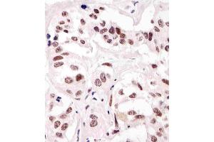 (ABIN387785 and ABIN2838022) staining SUMO1 in human breast carcinoma tissue sections by Immunohistochemistry (IHC-P - paraformaldehyde-fixed, paraffin-embedded sections). (SUMO1 antibody)