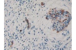 Detection of THBS3 in Human Pancreatic cancer Tissue using Polyclonal Antibody to Thrombospondin 3 (THBS3) (THBS3 antibody  (AA 670-921))