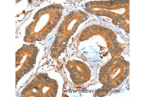 Immunohistochemistry of Human colon cancer using ACOT11 Polyclonal Antibody at dilution of 1:40