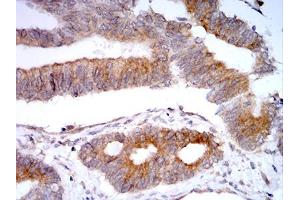 Immunohistochemical analysis of paraffin-embedded rectum cancer tissues using VIMP mouse mAb with DAB staining. (Selenoprotein S antibody  (AA 1-187))