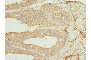 Immunohistochemistry of paraffin-embedded human endometrial cancer using ABIN7146875 at dilution of 1:100 (CSNK1G1 antibody  (Isoform gamma 1))