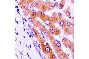 Immunohistochemical analysis of GAS2 staining in human liver cancer formalin fixed paraffin embedded tissue section. (GAS2 antibody)