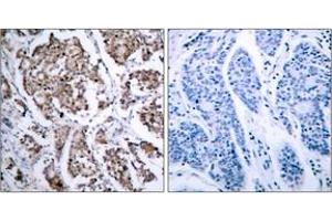 Immunohistochemistry analysis of paraffin-embedded human breast carcinoma, using BAD (Phospho-Ser155) Antibody. (BAD antibody  (pSer118))