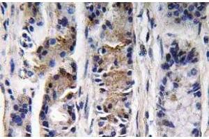 Immunohistochemistry (IHC) analyzes of Pepsin C antibody in paraffin-embedded human lung carcinoma tissue. (PGC antibody)
