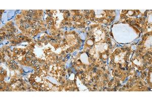 Immunohistochemistry of paraffin-embedded Human thyroid cancer using ANXA3 Polyclonal Antibody at dilution of 1:35 (Annexin A3 antibody)