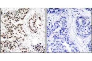 Immunohistochemistry analysis of paraffin-embedded human lung carcinoma, using Chk2 (Phospho-Thr68) Antibody.
