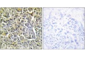 Immunohistochemistry analysis of paraffin-embedded human lung carcinoma tissue, using Collagen VI alpha2 Antibody. (COL6A2 antibody  (AA 691-740))