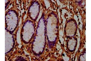 IHC image of ABIN7165044 diluted at 1:600 and staining in paraffin-embedded human gastric cancer performed on a Leica BondTM system. (AMN antibody  (AA 25-163))