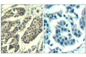 Immunohistochemical analysis of paraffin-embedded human breast carcinoma tissue using Cyclin B1 (phospho-Ser147) Antibody (E011540). (Cyclin B1 antibody  (pSer147))