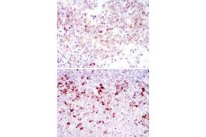 Immunohistochemical analysis of paraffin-embedded human cervical cancer tissues (upper) and tonsil tissues (bottom) using CTTN monoclonal antibody, clone 4C6  with DAB staining. (Cortactin antibody)