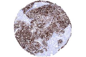 Invasive urothelial carcinoma of the kidney pelvis with strong Upk1a positivity (UPK1A antibody  (AA 114-173))