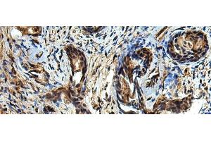 Immunohistochemistry of paraffin-embedded Human prost at e cancer tissue using TBCC Polyclonal Antibody at dilution of 1:80(x200) (TBCC antibody)