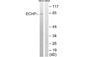 Immunohistochemistry analysis of paraffin-embedded human breast carcinoma tissue using EHHADH antibody. (EHHADH antibody  (Internal Region))