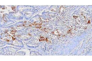 Paraffin embedded sections of human colon cancer tissue were incubated with FABP1 monoclonal antibody, clone 2G4  (1:100). (FABP1 antibody  (AA 1-127))