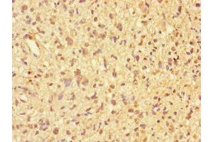 Immunohistochemistry of paraffin-embedded human glioma using ABIN7169250 at dilution of 1:100 (PPP2R2D antibody  (Regulatory Subunit B))