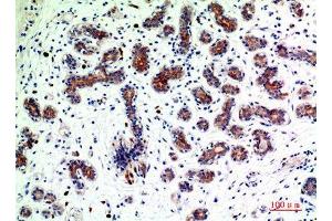 Immunohistochemistry (IHC) analysis of paraffin-embedded Human Breast Cancer, antibody was diluted at 1:200. (BMP2 antibody  (Internal Region))