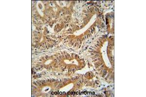 CCDC123 antibody immunohistochemistry analysis in formalin fixed and paraffin embedded human colon carcinoma followed by peroxidase conjugation of the secondary antibody and DAB staining. (CEP89 antibody  (C-Term))